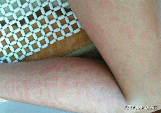 由于免疫系统完善,不会出现任何的症状,艾滋病患者则不同,由于免疫
