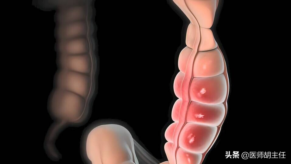 肠癌来临前，会先经历3个症状！劝告：这些高危人群不要忽略