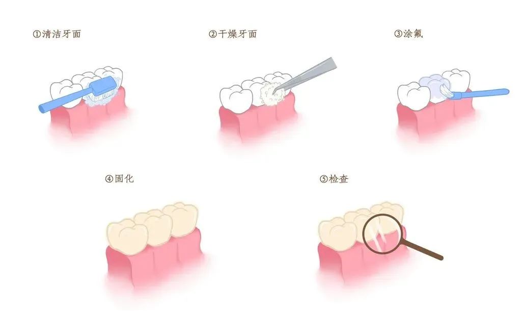 【健康口腔行动】儿童牙齿涂氟，向蛀牙宣战