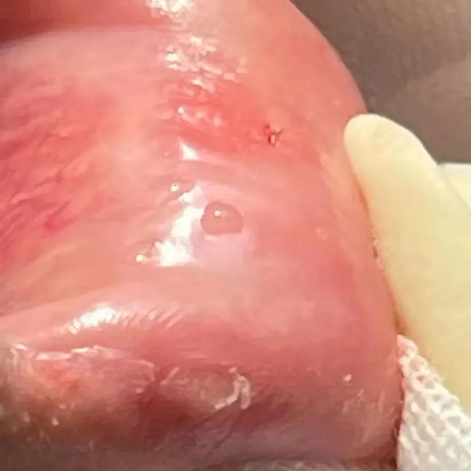 仁医新术｜口干舌燥也能治？改良式微创唇腺活检术了解一下