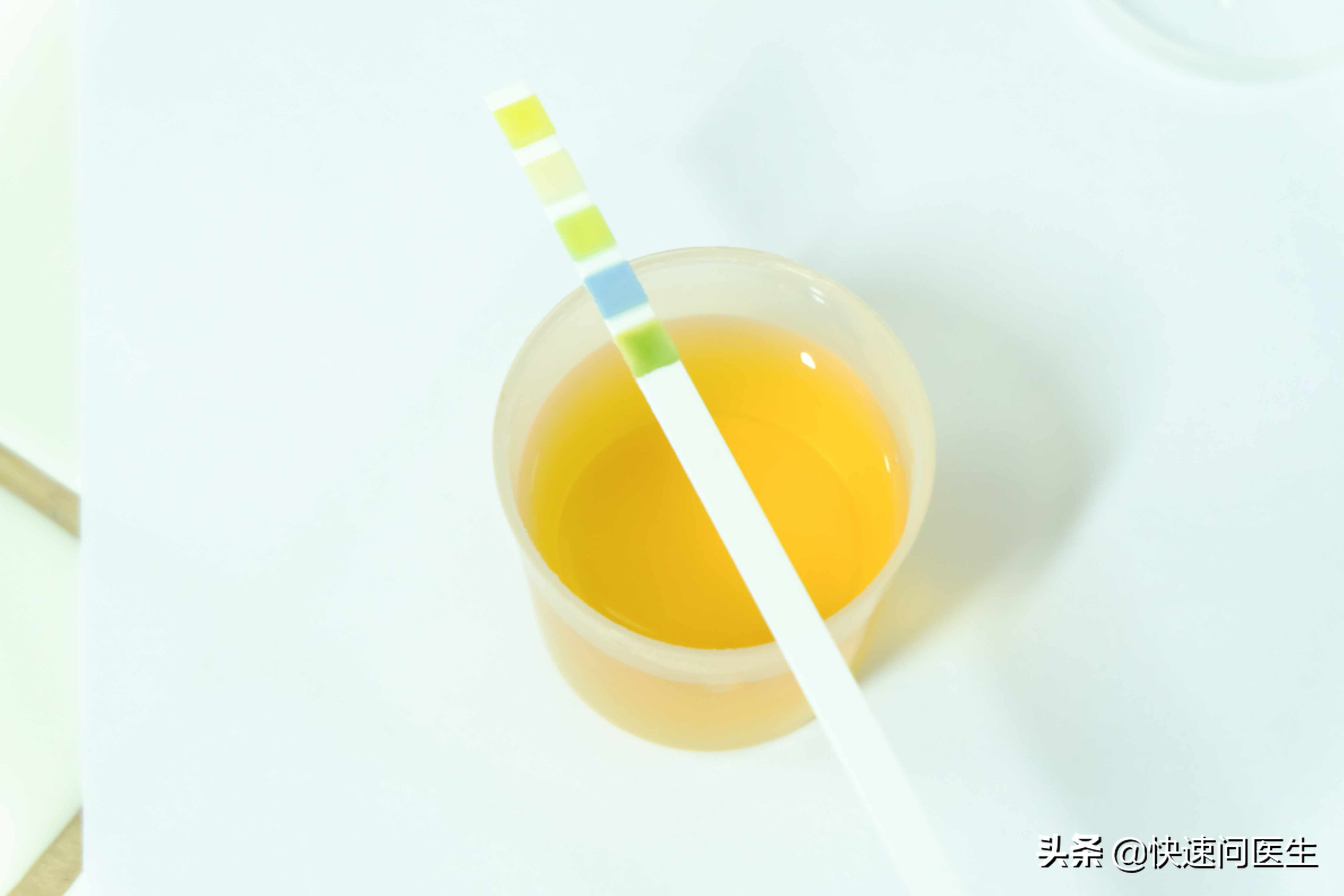 尿蛋白1 是肾不好?肾不好看哪些尿液指标