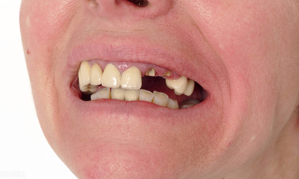 戴假牙要如何护理？这5个注意事项要牢记