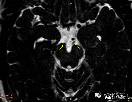 12对脑神经记忆口诀及图谱，别说你没见过