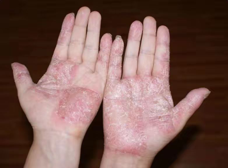 工作的需要,这个问题越来越困扰着小李,一开始,他听朋友说这是湿疹