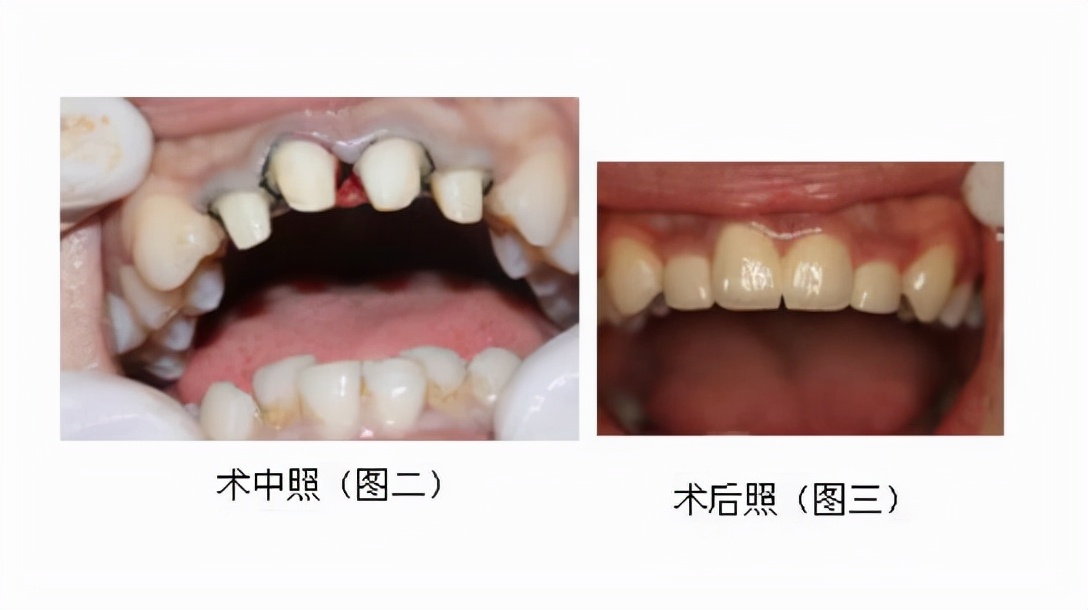 烤瓷牙好处多，但我却不推荐你做，为什么？