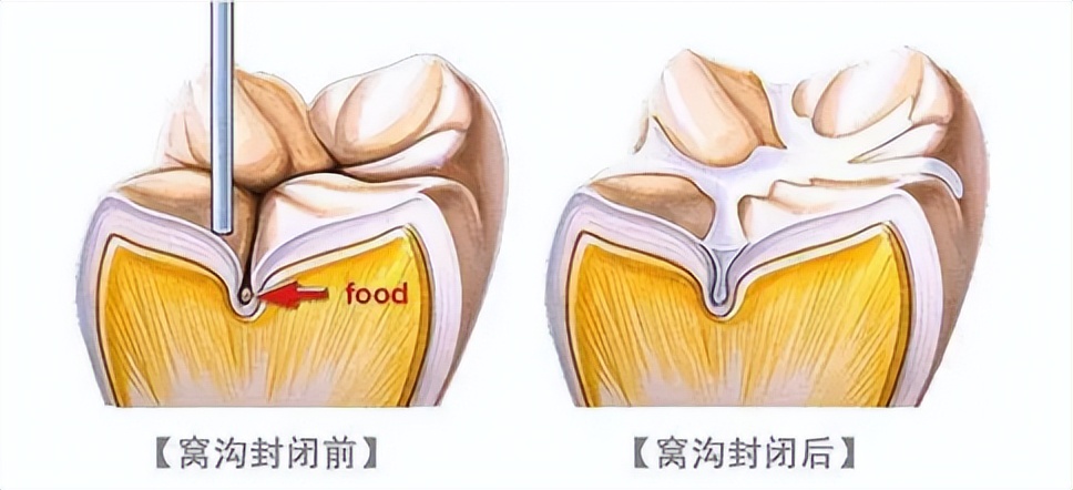 02窝沟封闭,可以降低90%以上的龋齿率