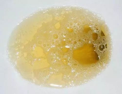 异常信号②蛋白尿/泡沫尿