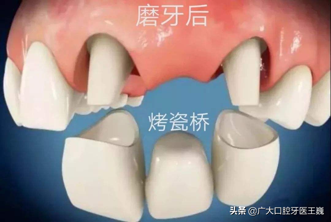 牙齿缺了，劝你一定要知道这两种修复办法