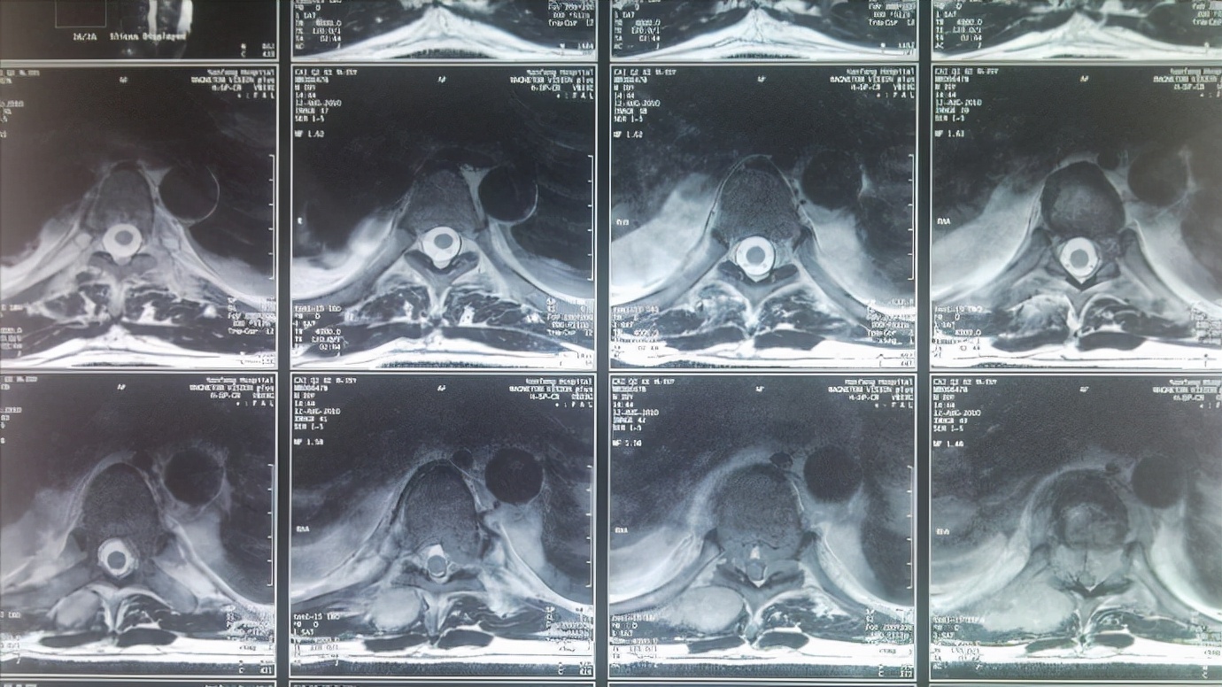 x光看不清,ct辐射大,腰突为什么不直接做核磁共振?有何区别