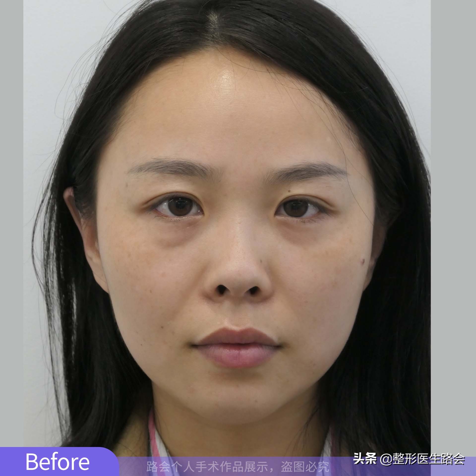 拒绝“自体骨隆鼻”，28岁姑娘独自来京整形，后天术后109天气质改变