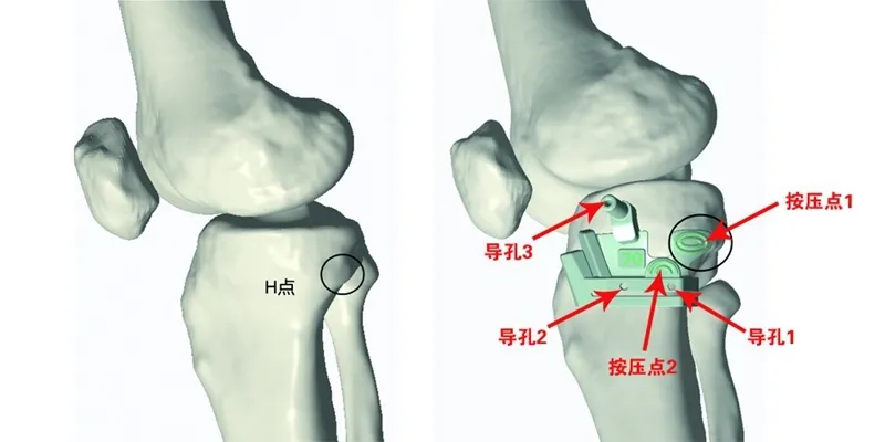 一种基于“H”点的全新3D打印个性化截骨导板辅助胫骨高位截骨术