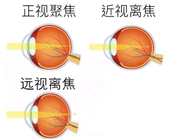 离焦近视眼镜的优缺点-第2张图片-华展网