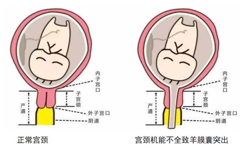 孕妈打个喷嚏就流产了，这到底怎么回事？