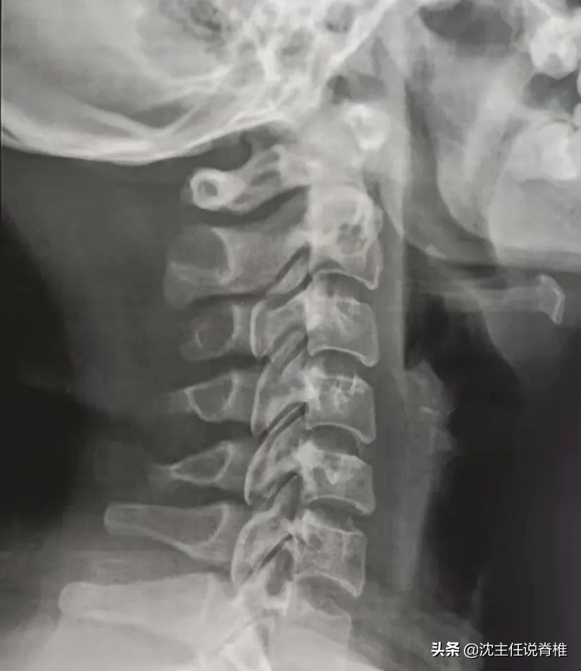 颈椎曲度变直怎么办？这位病人只做了2件事，一年后恢复正常
