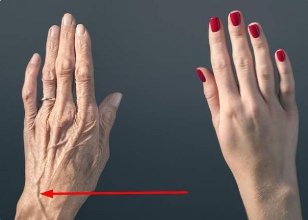 有些人手臂上“青筋暴起”，有些人却看不到青筋，哪种更健康呢？