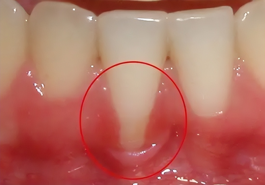 牙齦萎縮是怎麼引起的？