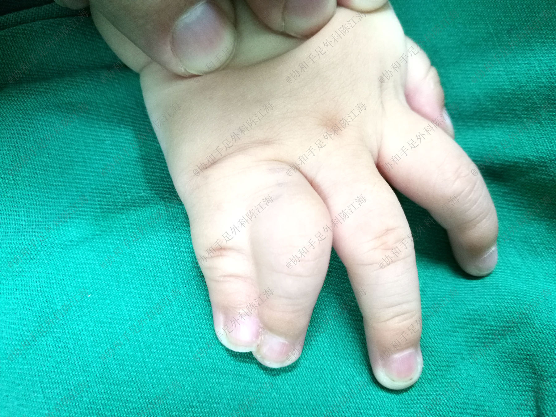 宝宝并指手术需植皮，妈妈哭求用自己的，医生：现在有免植皮技术-春雨医生
