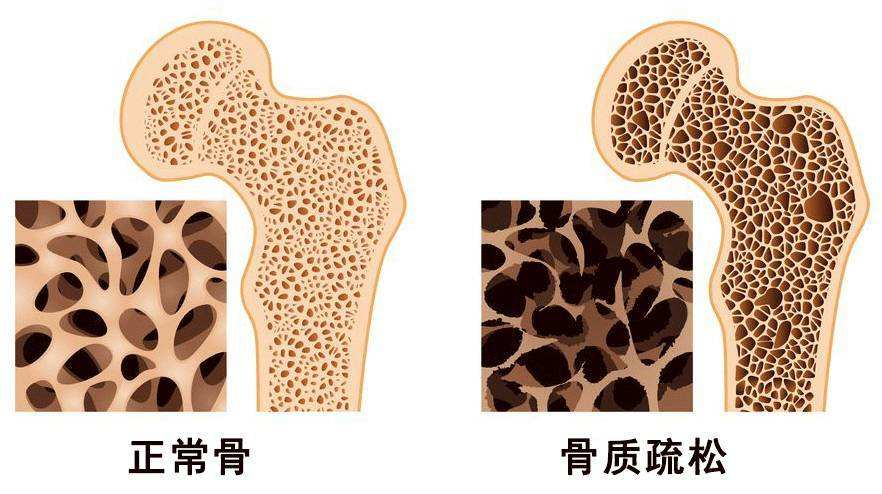 “唑来膦酸”真是抗骨质疏松的神药？靠谱吗？骨科医生给您讲真相