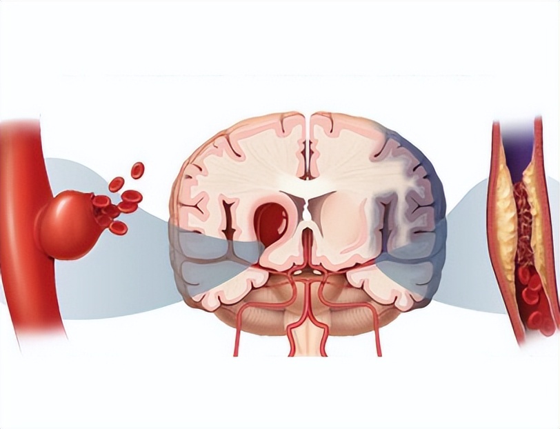 脑动脉瘤如何确诊？3种方式帮助你