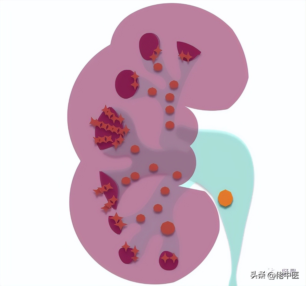 (海绵肾)海绵肾,是指肾脏长得像海绵吗?