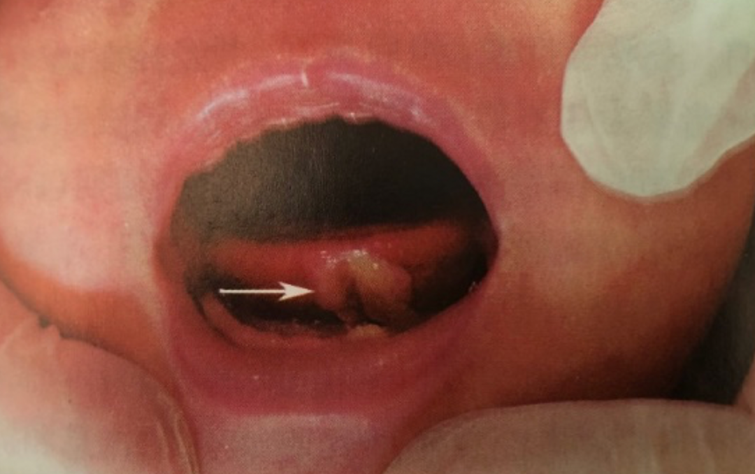 婴儿哭舌底下有个缺口图片