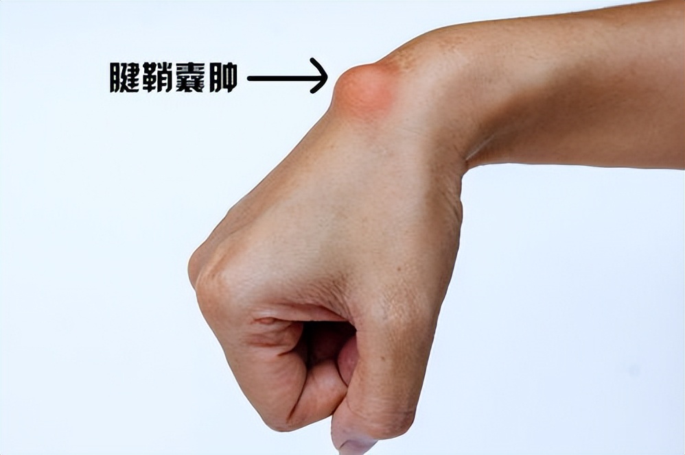 腱鞘囊肿怎么治疗 腱鞘囊肿吃什么药最好-大连问答网