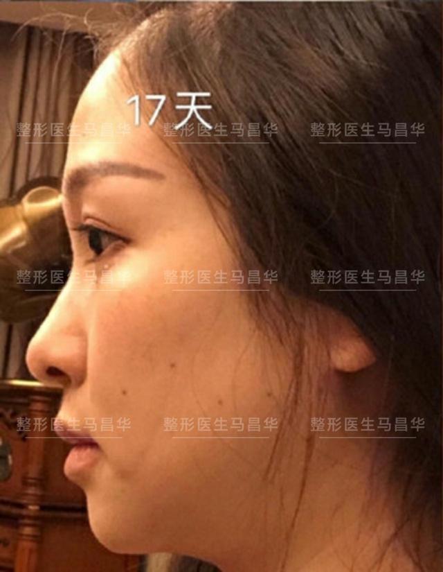 面部下颌缘吸脂术后即刻分享，面吸术后30天，她说她变回妙龄少女