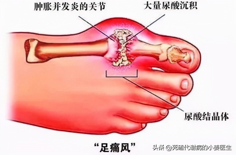 中药治急性痛风，小心清热利湿太过导致肿痛复发或加重！啥道理？