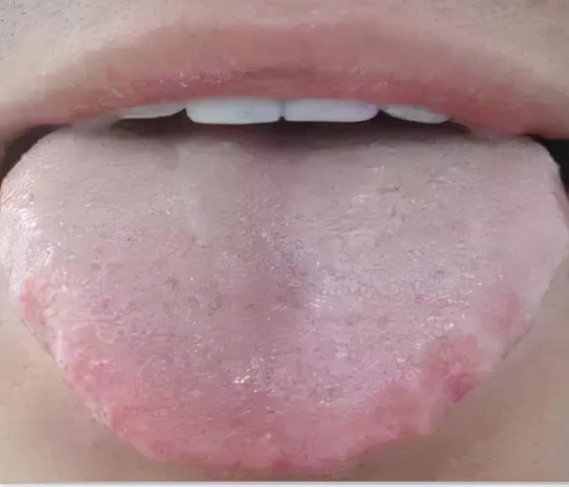 舌头边缘有齿痕，舌苔中间有裂纹？3种齿痕5种裂纹，你是哪一种？