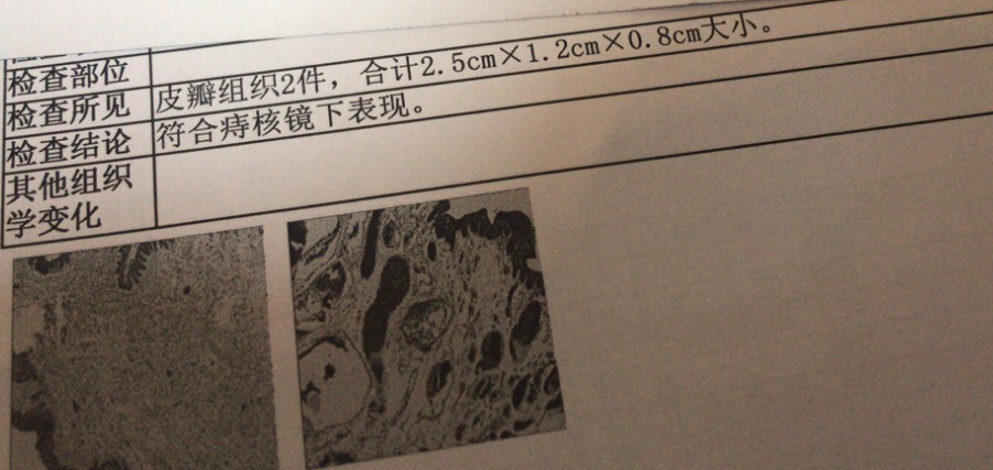 司机憋出混合痔，与痔相伴20年，这种成年老痔医生应该怎么治？