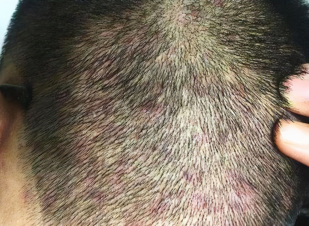 头上长疙瘩怎么治疗(为何头皮总长)
