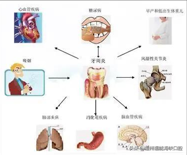 无法保留！29岁女子因牙周炎掉一大半牙！你的牙周还好吗？