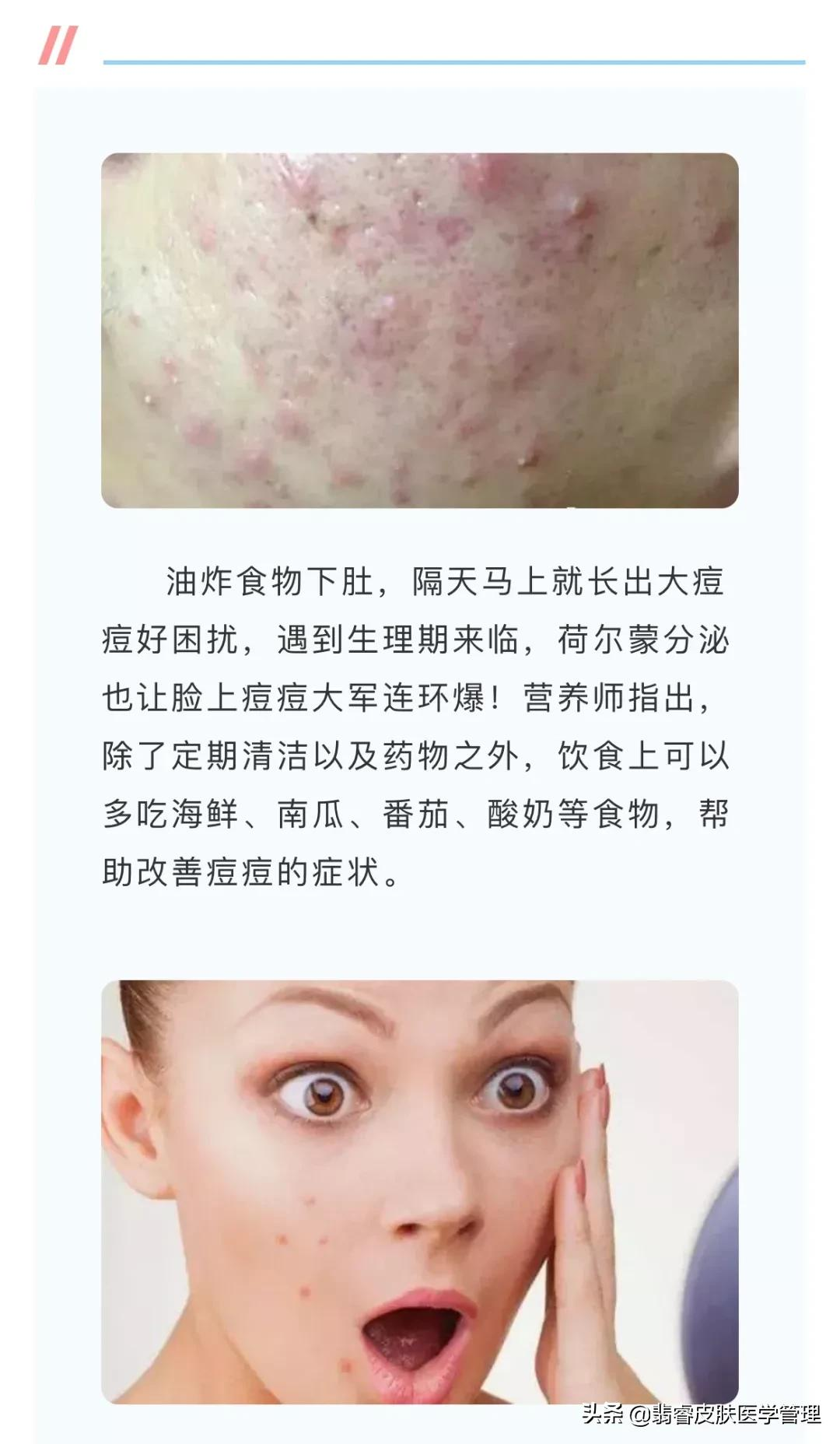 这四种饮食方法比药还灵,和痘痘说拜拜啦