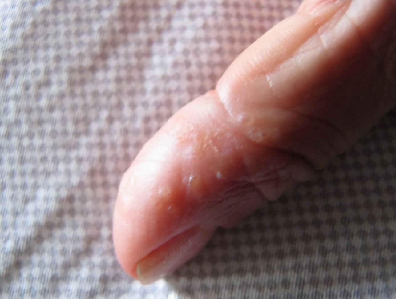 医生:当心是"汗疱疹"