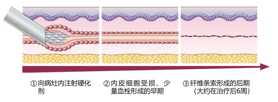 微创、无疤、随治随走-----下肢静脉曲张的硬化剂治疗