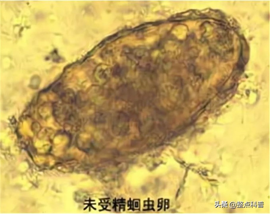 幾十年前 幾乎人人肚子裡都有的蛔蟲 為什麼現在沒有聽說過了 天天看點