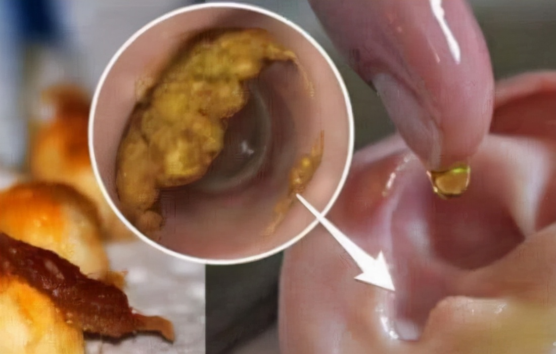 为什么有的人“耳屎”是湿的，有的是干的？或许与这件尴尬事有关