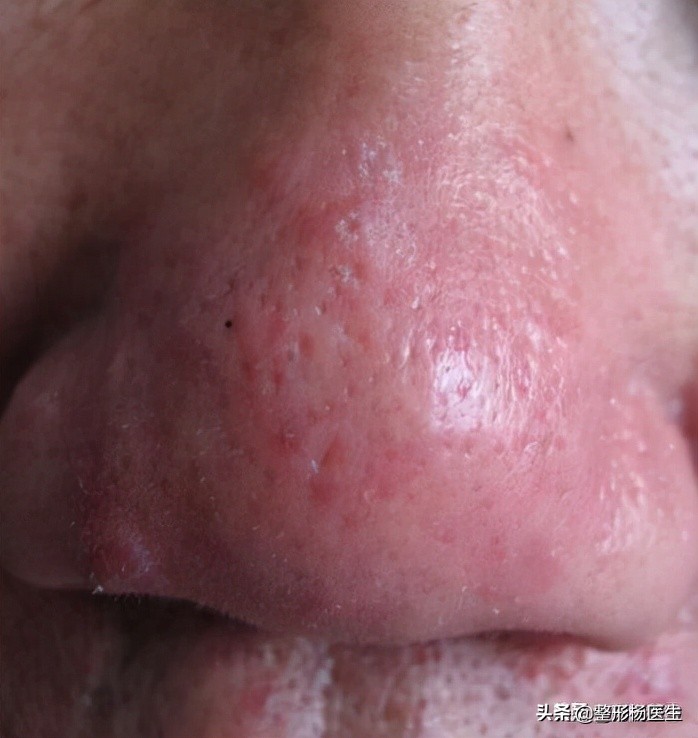 科普:什么是酒渣鼻?不看不知道,一看吓一跳