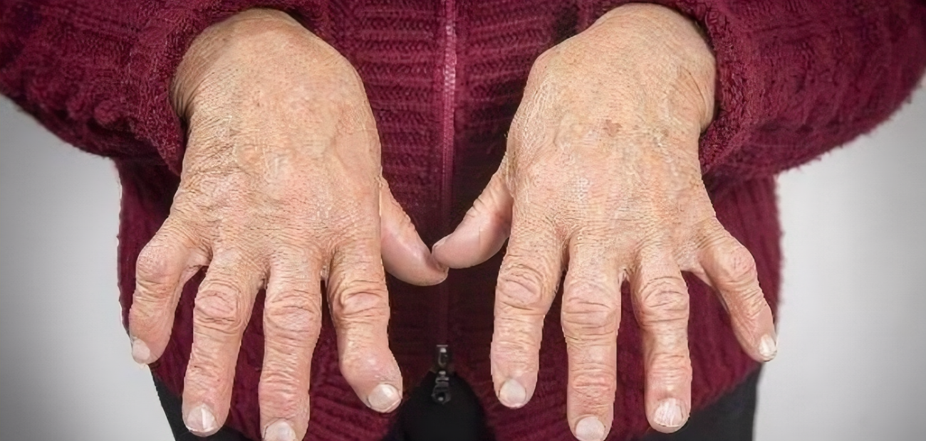 难治性类风湿关节炎的治疗?中医辨证痰瘀痹阻,祛湿通络见奇效