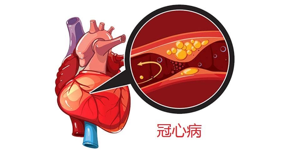 他汀药降血脂，十元一粒的和几毛钱的，差异有多大？本文为您讲清