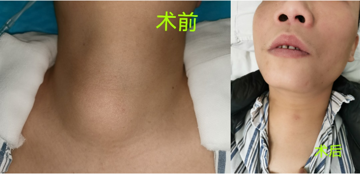 广西甲状腺结节去哪里治疗(甲状腺囊实性结节治疗新选择——微波消融助力实现“去病无痕”)