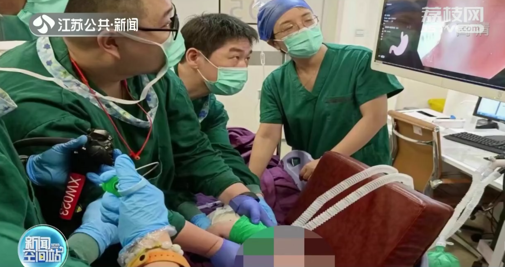 泰州4个月宝宝扯下奶奶耳坠吞下肚 医生胃镜手术取出