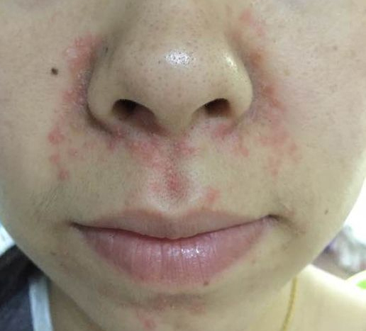 皮炎症状图片 各种皮炎症状图片-百科叔叔