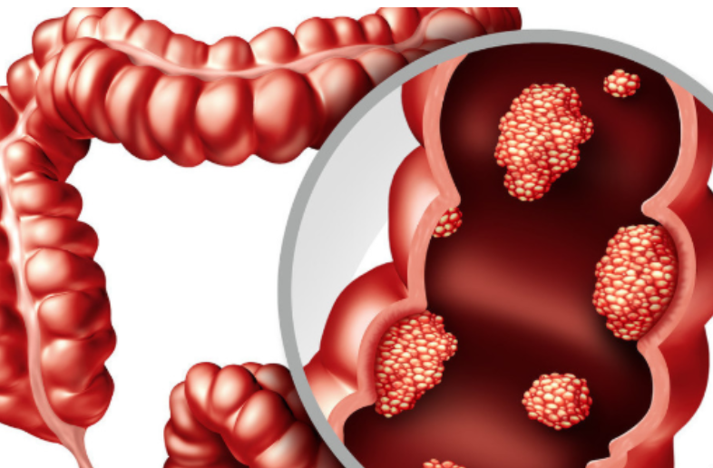 腸息肉是腸癌最大的禍根,如何不讓息肉再生長?3件事要做