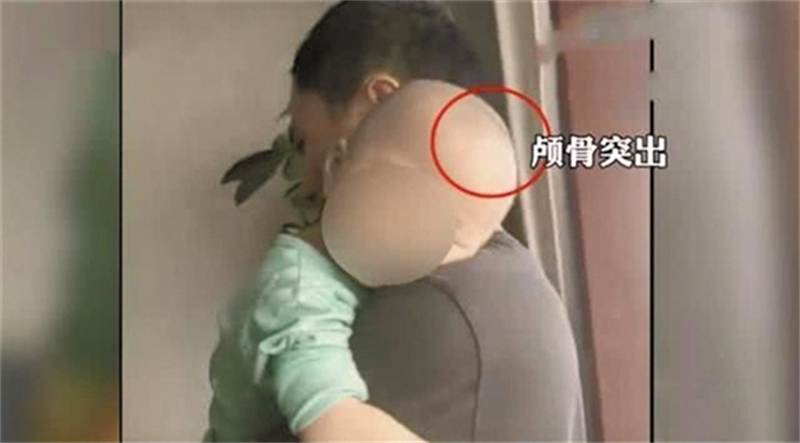 三聚氰胺事件14年，被奶粉毒害的孩子现在怎样了？透析才能活下去