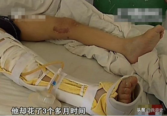 真实故事：山东17岁男孩无痛感汗腺，自我伤害博痛觉，父母泪崩