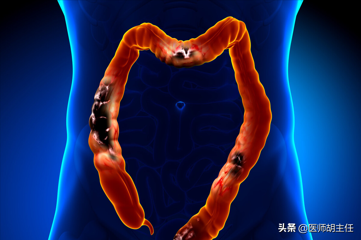 腸癌同其他很多癌症一樣,早期通常沒有明顯症狀,直至癌腫生長到一定