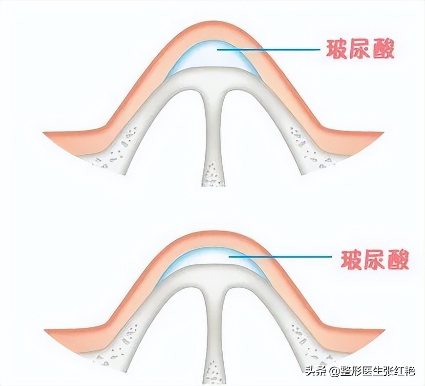 注射隆鼻效果怎么样（注射玻尿酸后做鼻综合，算初鼻还是修复？）