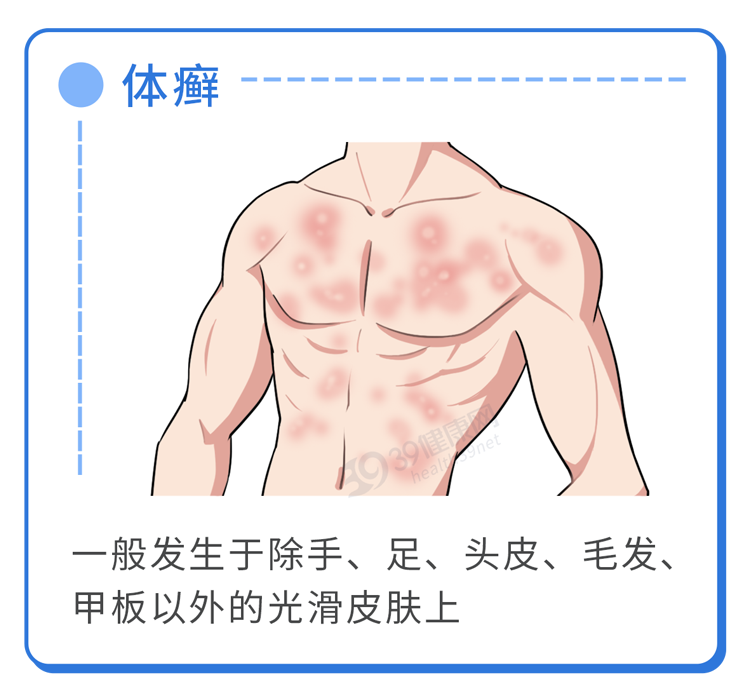 怎么样治疗灰指甲(得了灰指甲，反复发作很难受？一次性介绍3种药，总有一款能起效)