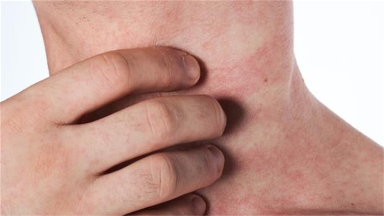 尤其是急性期的患者,皮肤病较为明显.